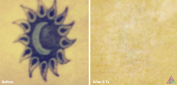 Before and after tattoo removal